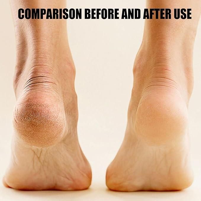 Electronic Pedicure Tool – Rechargeable Foot Callus Remover for Smooth & Soft Feet
